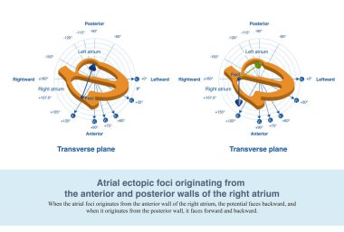Sağ atriyumun ön ve arka duvarlarından kaynaklanan atriyal odaklanma ters P dalgası ve sırasıyla V1 öncülüğünde pozitif ve negatif bifazik P dalgası oluşturur..