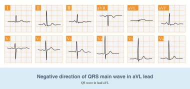 AVL liderliğindeki QRS ana dalgasının olumsuz yönü