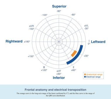 Ön kurşun sisteminde, anatomik transpozasyon ve elektriksel transmisyon iyi bir anlaşma içinde değildir, çünkü bazı elektriksel transmisyonların anatomiyle hiçbir ilgisi yoktur..