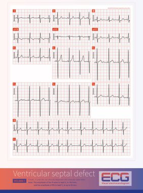 Ventriküler septal kusurlar, sol ventriküler hipertrofi, biventriküler hipertropi veya sağ ventriküler hipertropi ECG mevcut olabilir..