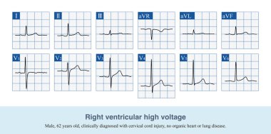 Yetişkinlerde kurşun V1 'in R dalgası genişliği 6 mm' yi aştığında ve organik kalp hastalığı ya da başka bir hastalık elektrokardiyogram değişimi olmadığında, basit bir sağ ventriküler yüksek voltajdır..
