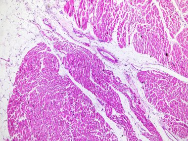 Sol ventriküler hipertropi sık sık hipertansiyon, aort kapakçığı stenozu, miyokardiyal hipertroz, düzensiz hücre düzensizliği ve interstiyal fibrozis gibi hastalıklarda görülür. 40x büyüt.
