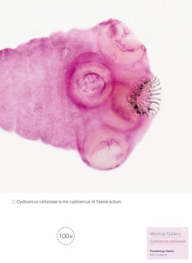 Cysticercus cellulosae is the cysticercus of Taenia solium, which can parasitize human brain, skin and eyes. This picture focuses on the scolex.Magnify 100x. clipart