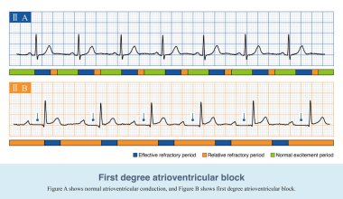 Birinci derece atrioventriküler blokta, PR aralığı 200 metreden fazla uzadı ve ECG 'de QRS dalga kaybı yaşanmadı. Engelleme alanı iletim sisteminin herhangi bir yerinde meydana gelebilir.