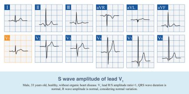 Kardiyak döngüyü ölçerken, kararlı ECG dalga formunu seçin ve ölçüm referans noktasıyla aynı noktadan ECG dalgalarını seçin.