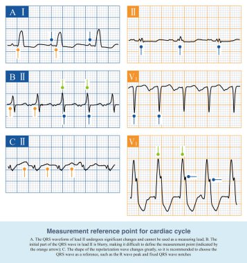 Birinci derece atriyoventriküler bloğun elektrokardiyogram tanısı nispeten basittir, yetişkin halkla ilişkiler aralığı 200 metreden fazladır ve QRS dalgası sızıntısı yoktur..