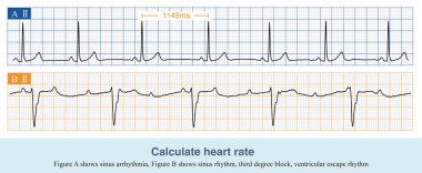 Atriyum ve ventrikül 1 / 1 iletkenlik ilişkisini sürdürdüklerinde atriyal oran ve ventriküler oran aynıdır, aksi takdirde ayrı ayrı değerlendirilmeleri gerekir..