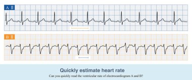 EKG kağıdında, beş küçük kare bir orta kare oluşturur. 300 'ü komşu ECG dalgaları tarafından işgal edilen orta karelerin sayısına bölerek kalp atışını elde ederiz..