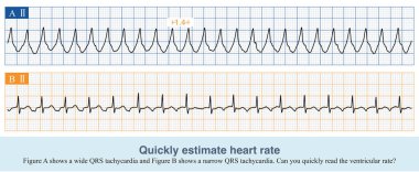 EKG kağıdında, beş küçük kare bir orta kare oluşturur. 300 'ü komşu ECG dalgaları tarafından işgal edilen orta karelerin sayısına bölerek kalp atışını elde ederiz..