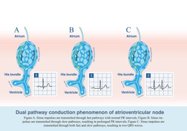 EKG kağıdında, beş küçük kare bir orta kare oluşturur. 300 'ü komşu ECG dalgaları tarafından işgal edilen orta karelerin sayısına bölerek kalp atışını elde ederiz..