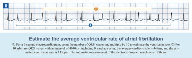 Atrial fibrilasyon kesinlikle düzensiz ventriküler ritmi olan bir aritmidir ve ventriküler oran sadece ortalama kardiyak döngü veya QRS dalgalarının sayısına göre tahmin edilebilir..