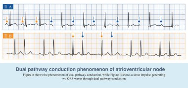 EKG kağıdında, beş küçük kare bir orta kare oluşturur. 300 'ü komşu ECG dalgaları tarafından işgal edilen orta karelerin sayısına bölerek kalp atışını elde ederiz..