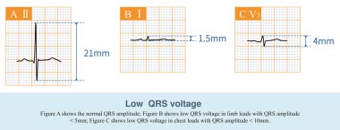 Kol ve bacağın genişliği 5 mm 'den az olduğunda, buna kol kurşun düşük voltaj denir ve göğsün QRS genliği 10 mm' den az olduğunda, buna göğüs kurşun düşük voltaj denir..