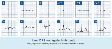 Eğer QRS dalga genişliği 5 mm 'den az ise ve göğüsteki QRS dalga voltajı normalse, buna düşük QRS voltajı denir..
