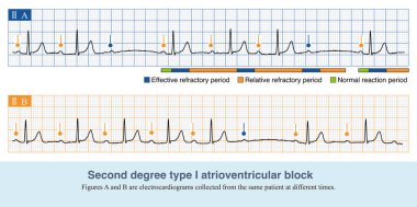PR aralığı QRS dalga yayılması ile kademeli olarak uzadığında, ECG tip I atrioventriküler bloktur. Bloke edilen alanların çoğu atrioventriküler düğümler..