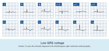 QRS dalga genliği 6 uzvun hepsinde 5 mm 'den az ve 6 göğüs ucu için de 10 mm' den az olduğunda elektrokardiyogram tanısı düşük QRS dalga tanısıdır..