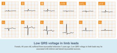 Tüm uzuvların QRS dalga genişliği 5 mm 'den azsa ve göğüs genişliği normalse, kol ve bacaklarda düşük voltajdır ve en yaygın neden genişletilmiş kardiyomiyopati..