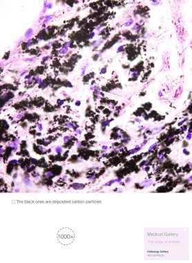 Sigara içenlerin akciğerlerinin patolojik fotoğrafları siyah maddenin karbon tozu içerdiğini gösteriyor. Bu da akciğer hastalıklarına ve COPD 'ye kolaylıkla sebep olabilir. 1000x büyüt.