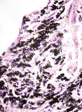 Sigara içenlerin akciğerlerinin patolojik fotoğrafları siyah maddenin karbon tozu içerdiğini gösteriyor. Bu da akciğer hastalıklarına ve COPD 'ye kolaylıkla sebep olabilir. 1000x büyüt.