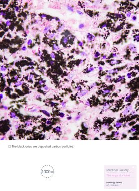 Sigara içenlerin akciğerlerinin patolojik fotoğrafları siyah maddenin karbon tozu içerdiğini gösteriyor. Bu da akciğer hastalıklarına ve COPD 'ye kolaylıkla sebep olabilir. 1000x büyüt.