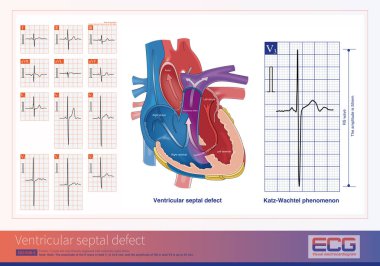 Ventriküler septal kusurlar, sol ventriküler hipertrofi, biventriküler hipertropi veya sağ ventriküler hipertropi ECG mevcut olabilir..