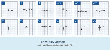 QRS dalgasının genliği tüm kol ve bacaklarda 5 mm 'den az ve göğüste 10 mm' den az olduğunda düşük QRS voltajı olarak teşhis edilir..
