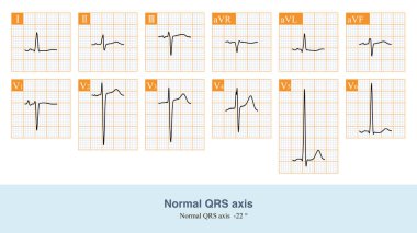 QRS 'nin ön ekseni -22 olduğunda, sol üst çeyreğe doğru yönelir ve kurşun III ekseninin negatif tarafına yansıtılır, dolayısıyla kurşun III' ün QRS ana dalgası negatiftir..