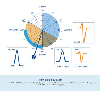 When the frontal QRS axis deviates to the right, the QRS main wave of lead I is negative, the QRS main wave of lead III is positive, and lead II can be positive or negative.