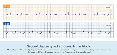 90% of the atrioventricular nodal arteries originate from the right coronary artery, therefore, patients with acute inferior myocardial infarction often have various types of atrioventricular blocks.