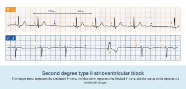 Hastalık koşulları altında, sol ve sağ ventriküler uyarılma arasındaki potansiyel ilişki değişir, bu da frontal QRS eksen sapmasının mekanizmasıdır..