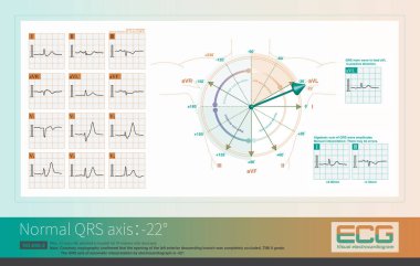 QRS ekseni -22 iken, ana QRS dalgası kurşun aVL 'de pozitiftir ve kurşun aVF' de negatiftir ve ortalama potansiyel AVL ekseninin pozitif tarafına paraleldir..