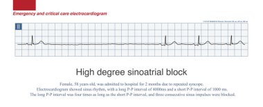 Uzun P-P aralığı temel sinüs P-P aralığının integral katıysa sinoatriyal bloktur. 2 kereden fazla olduğunda, yüksek sinüs bloğu oluşur..