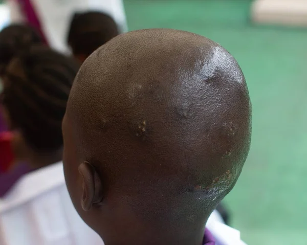 Back view of an unhealthy hairless African head infested with skin diseases like ring worm, enzymes, dandruff, lice among others