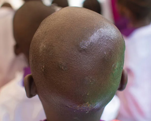 Back view of an unhealthy hairless African head infested with skin diseases like ring worm, enzymes, dandruff, lice among others
