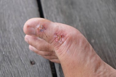 Yaralı ayak, hematom veya kontüzyonu olan lezyon.