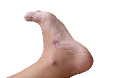 Yaralı ayak, hematom ya da ezilme olan lezyon, kesme yolu olan beyaz arka planda izole edilmiş.