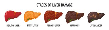 Karaciğer tahribatı aşamaları. Karaciğerli tıbbi poster. Tıbbi bir temada karaciğer vektör çizimi