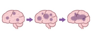 Alzheimer 'ın bunamasının vektör çizimi. beyin