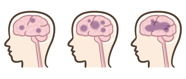 Alzheimer Bunamasının Vektör Çizimi Beyin — Stok Vektör