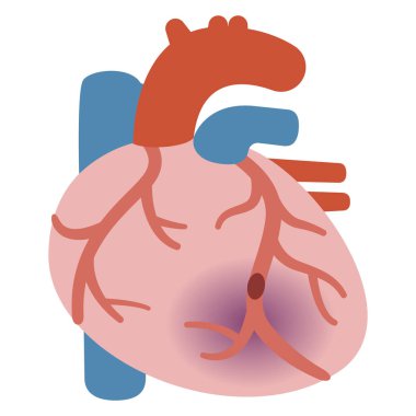 Miyokardiyal enfarktüsü olan bir kalbin vektör çizimi