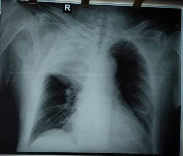 An X-ray examination showing pulmonary edema displays an excess of fluid in the lungs, which can cause difficulty breathing. The X-ray uses X-rays to produce images of the chest and is a diagnostic tool used to diagnose pulmonary edema.