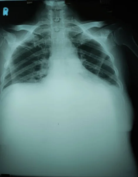 Chest X Ray of 65 years old man with cardiomegaly and pleural effusion