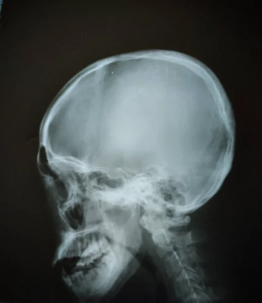A head X-ray is a diagnostic test that uses X-rays to produce images of the bones and structures in the head. It can diagnose conditions such as skull fractures, sinusitis, and tumors. The test is quick and painless, done in a radiology department.