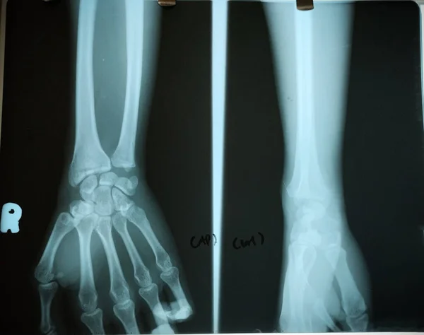 An X-ray picture of a hand bone is a diagnostic image produced by X-rays that shows the bones in the hand. It helps diagnose conditions such as fractures, arthritis, and other bone abnormalities.