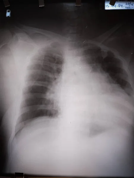 Chest X Ray of 65 years old man with cardiomegaly
