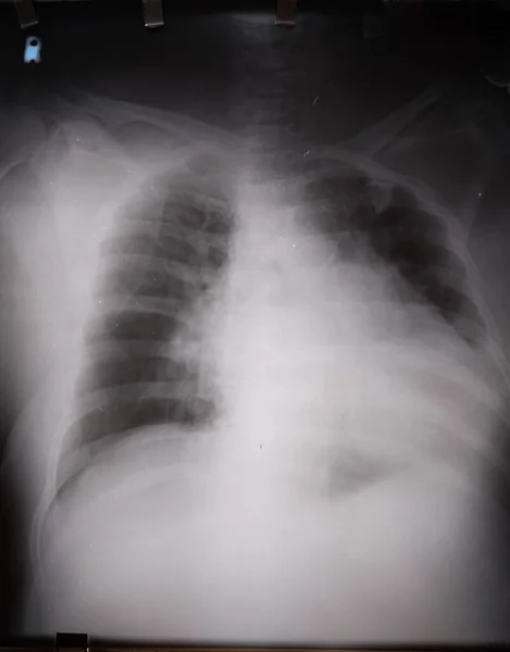 65 yaşındaki kardiyomegali hastasının göğüs röntgeni.