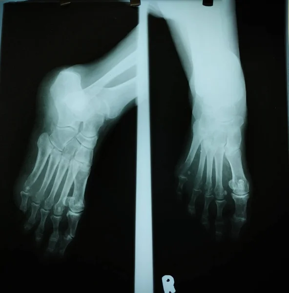 A foot X-ray is a diagnostic tool that uses X-rays to visualize the bones in the foot. It diagnoses fractures, arthritis and other bone problems. Patient positions foot in front of X-ray machine, X-rays create a shadow image.