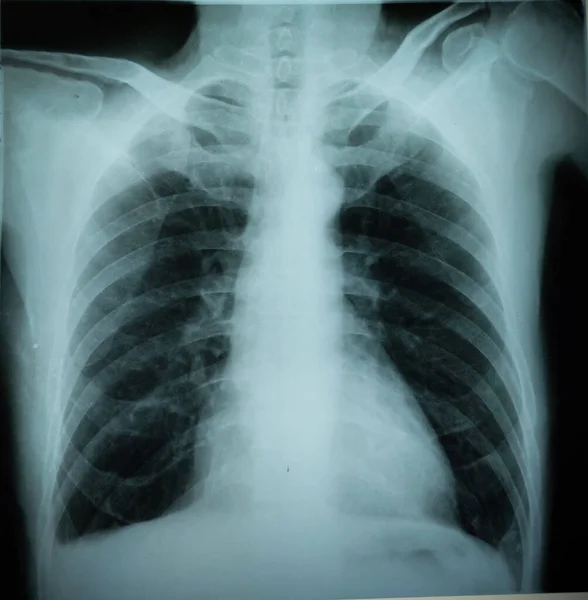 Chest X Ray of 60 years old man with chronic obstructive pulmonary disease