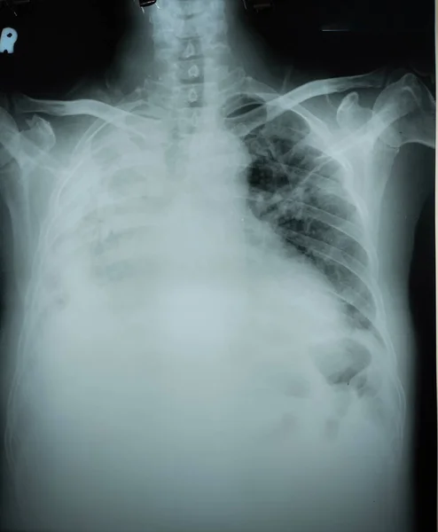 Chest X Ray of 60 years old mand with pulmonary oedema