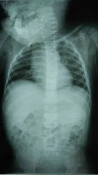 X Ray of baby with distended abdomen